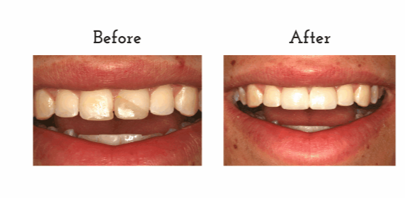 Before and After cosmetic bonding