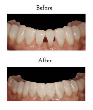 Before and After cosmetic bonding