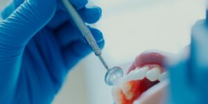 Fluoride treatment being done on a patient's teeth.