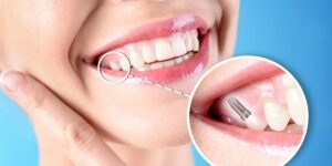 Dental implants shown in a woman's smile with a close-up view.