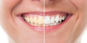 Before and after results of a Teeth Whitening Treatment.