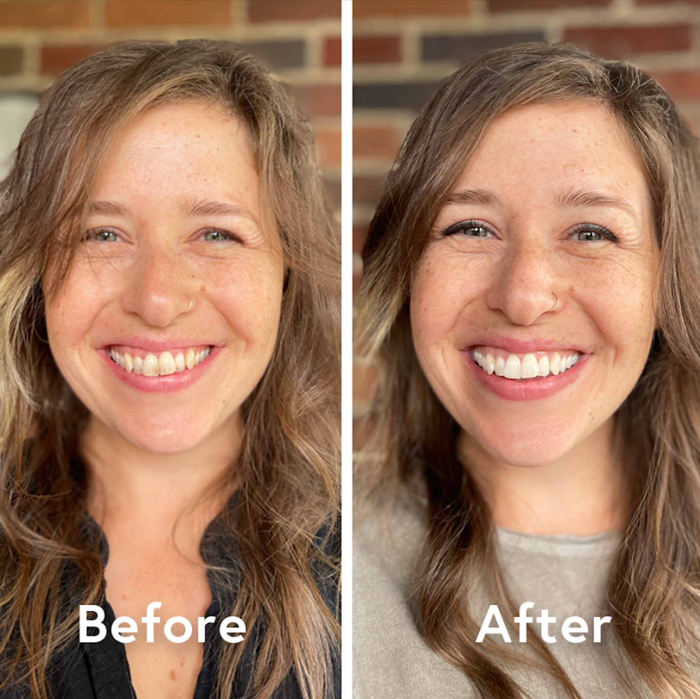 Before and after professional teeth whitening results showing a brighter, whiter smile transformation for a female dental patient.