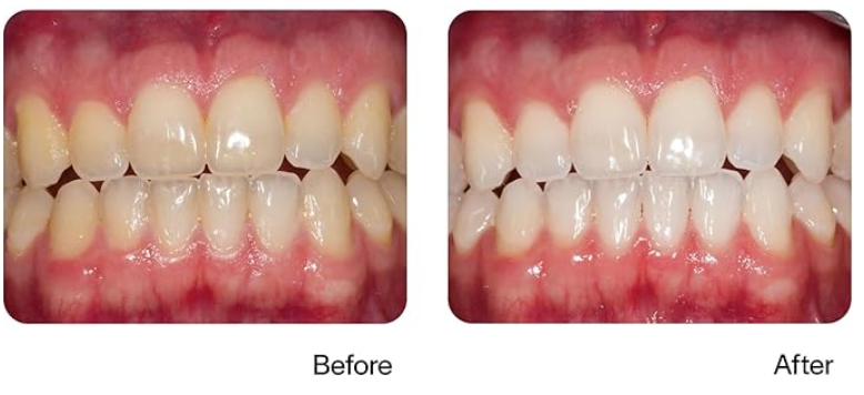 Before and after opalescence treatment