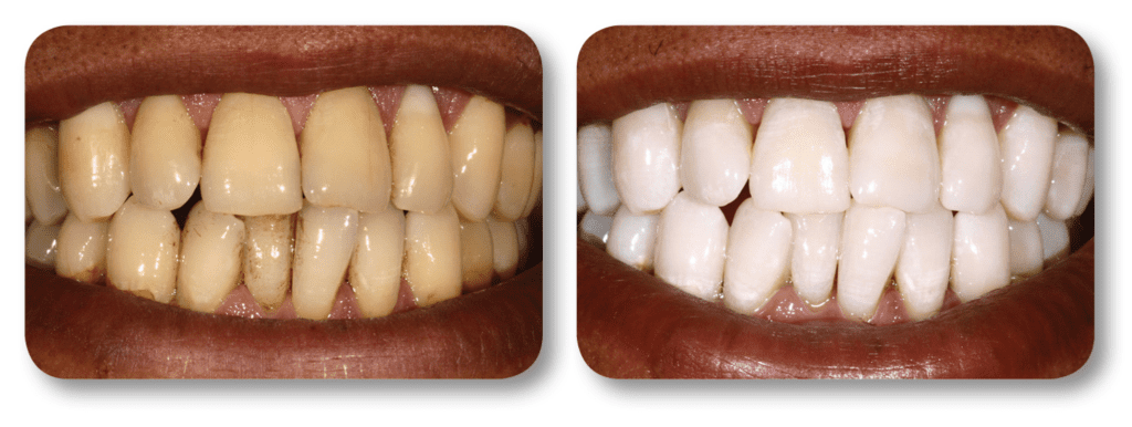 Before and after KoR whitening treatment