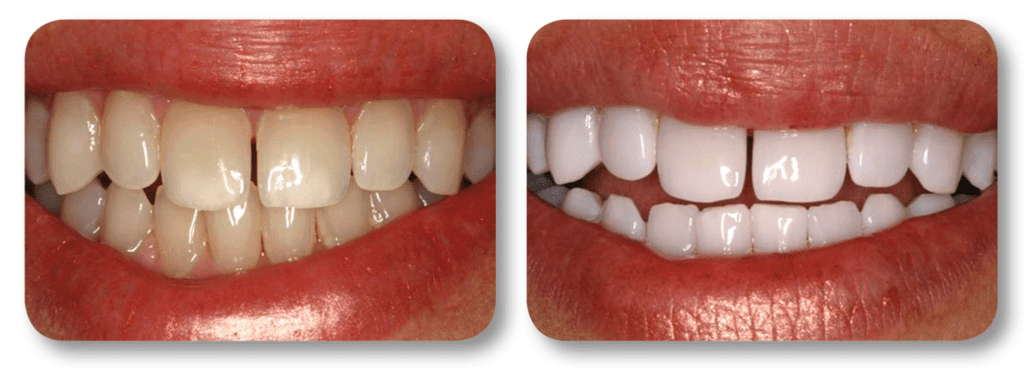 Before and after KoR whitening treatment