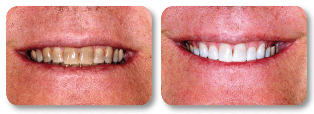 Before and after KoR whitening treatment