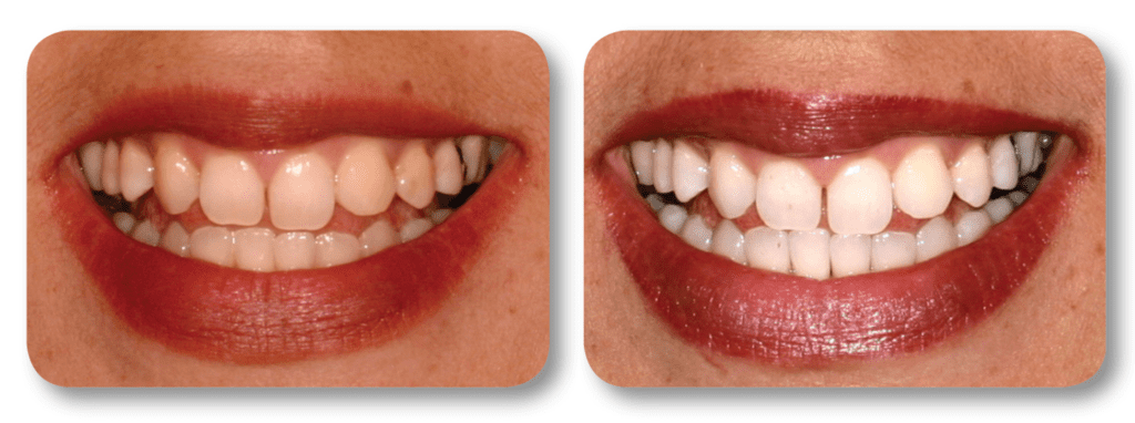 Before and after KoR whitening treatment